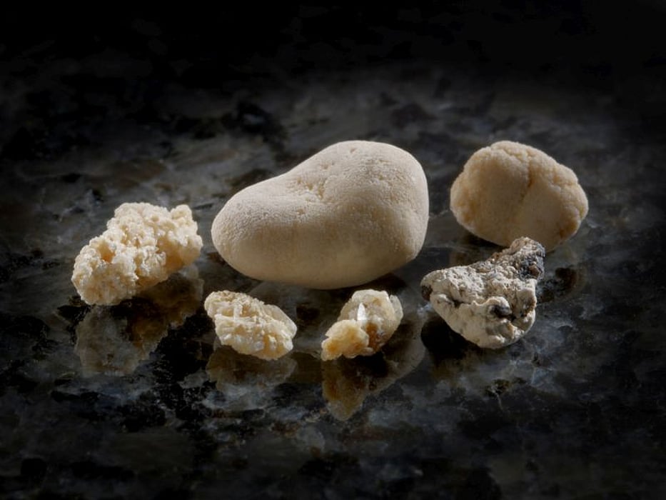 kidney stones