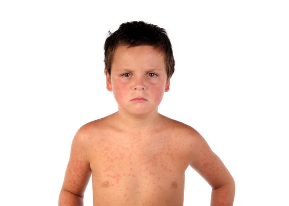 boy with measles