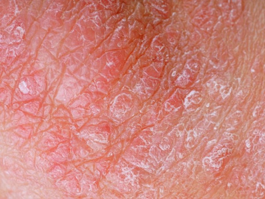 psoriasis