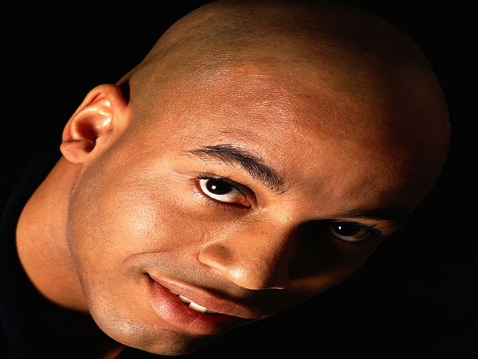Haywire Immune Cells May Help Cause Baldness - Consumer Health News | HealthDay Haywire Immune Cells May Help Cause Baldness - Consumer Health News | HealthDay
