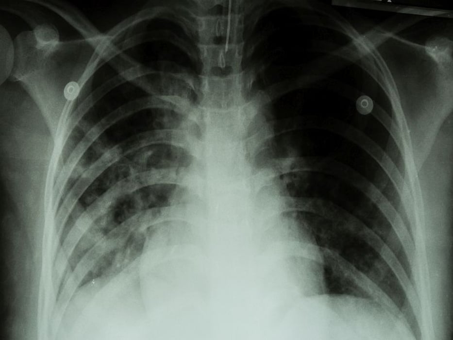 tuberculosis xray