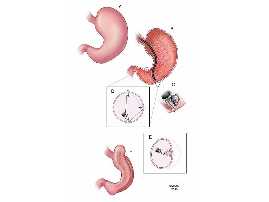 Endoscopic sleeve gastroplasty