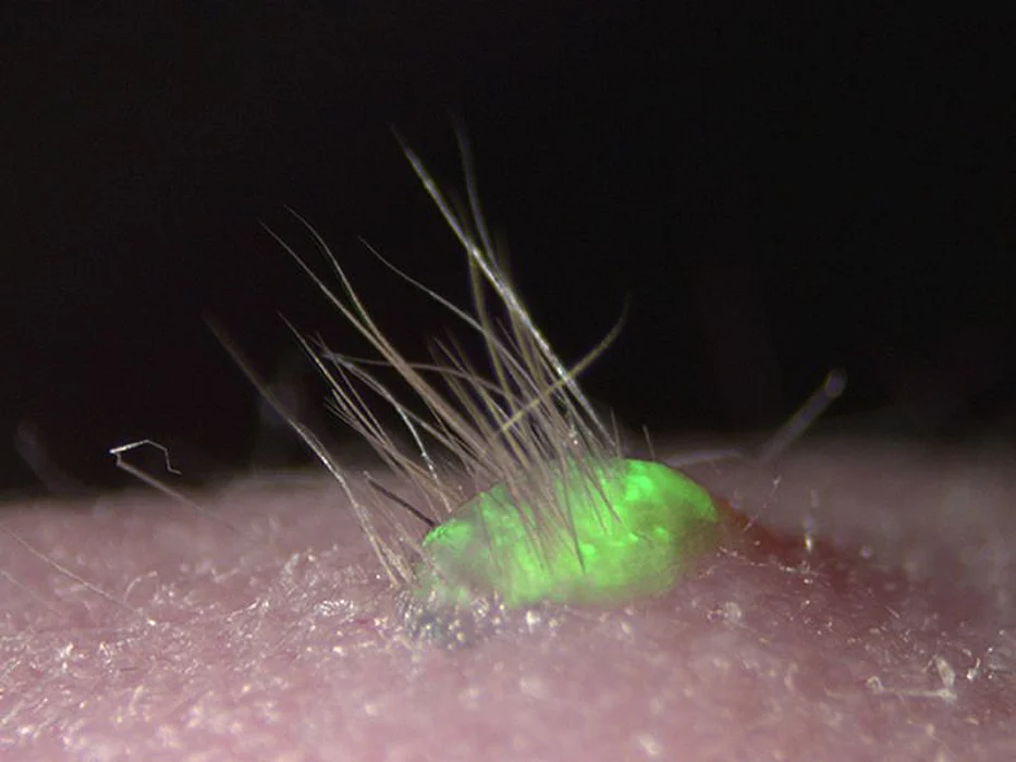 skin transplant