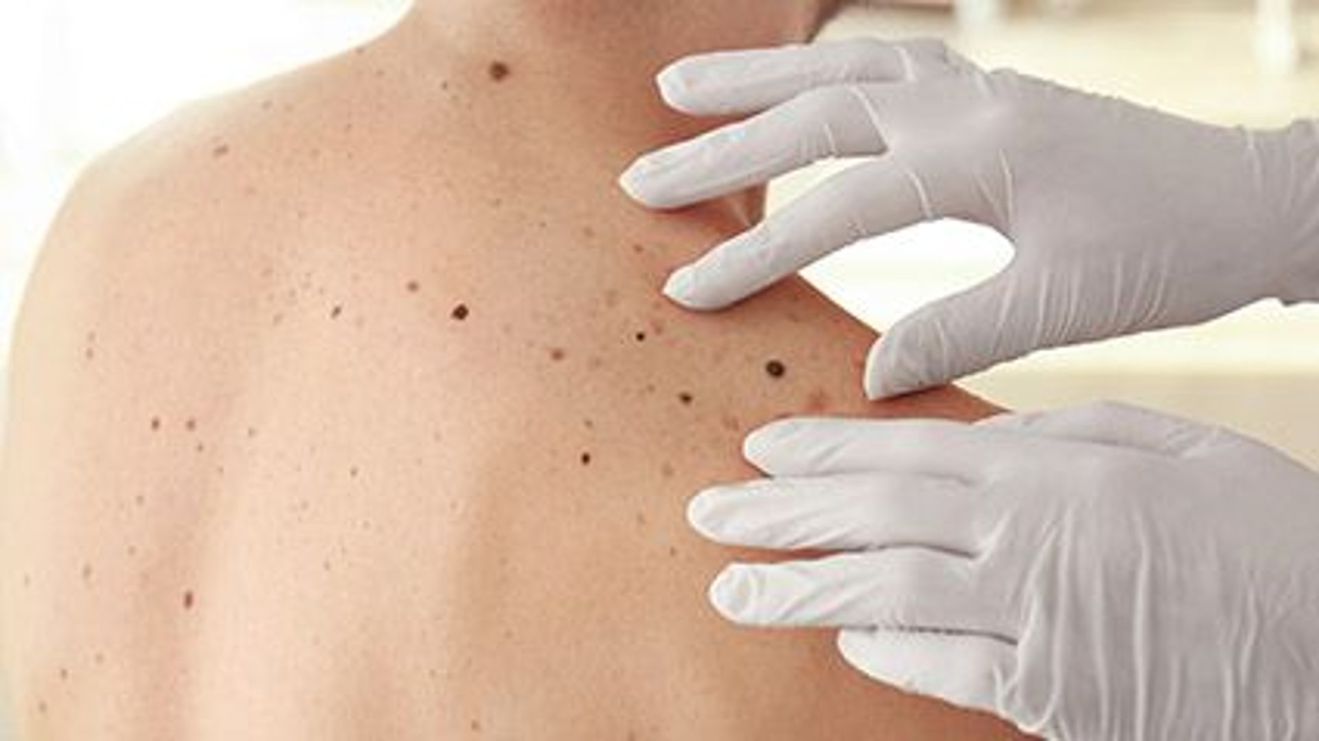 News Picture: Certain Melanoma Patients May Have Better Outcomes