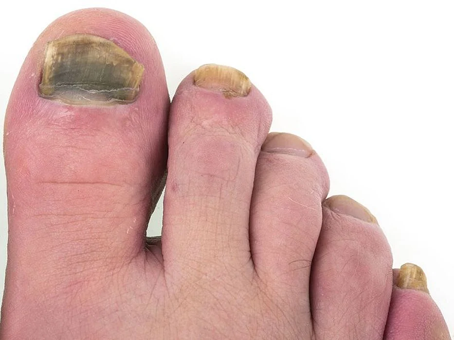 Nail Fungus