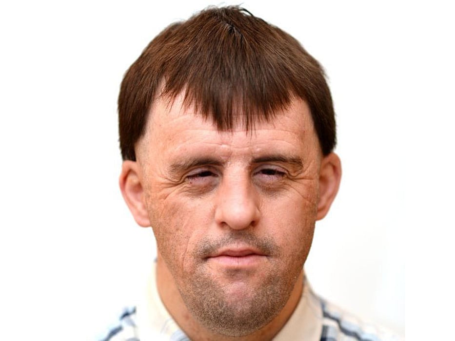 down syndrome
