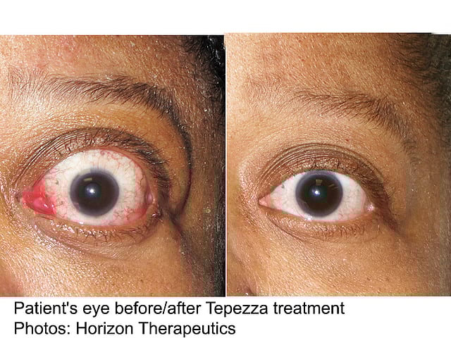 Teprotumumab Bests Placebo for Active Thyroid Eye Disease Consumer