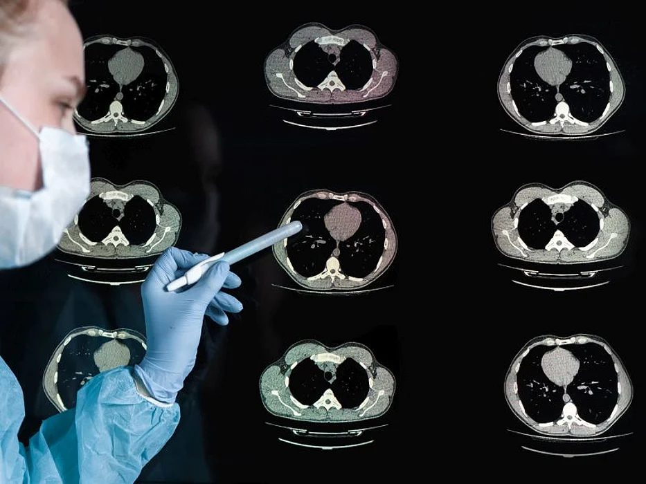 ct scan of lungs showing pneumonia and COVID-19