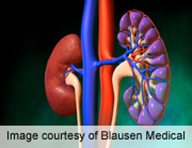 Drug Combo Helps LupusRelated Kidney Condition Consumer Health News