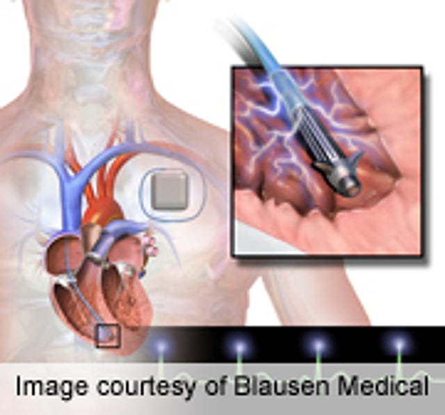 Implanted Defibrillator Patients Prefer Device Off if Very Ill Survey