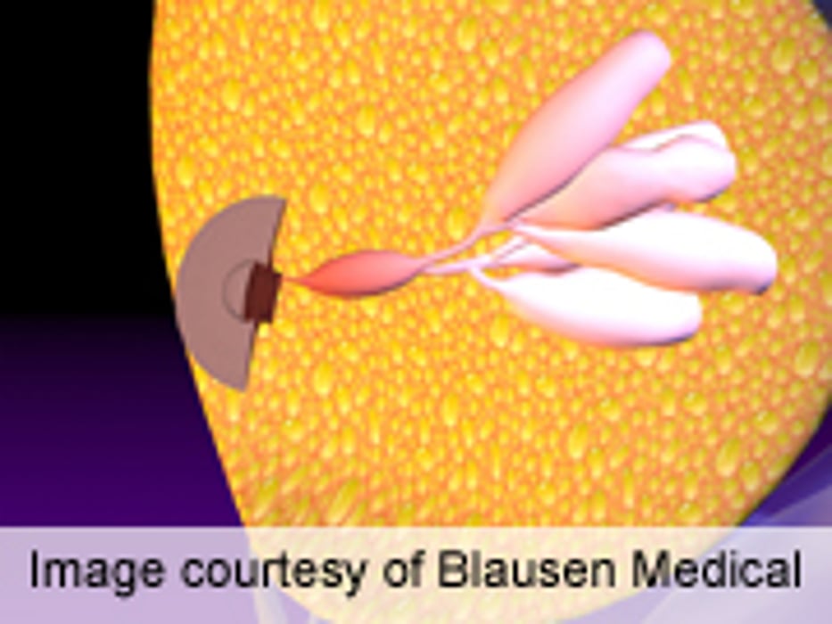 Subcutaneous, IV Trastuzumab Comparable for Breast Cancer