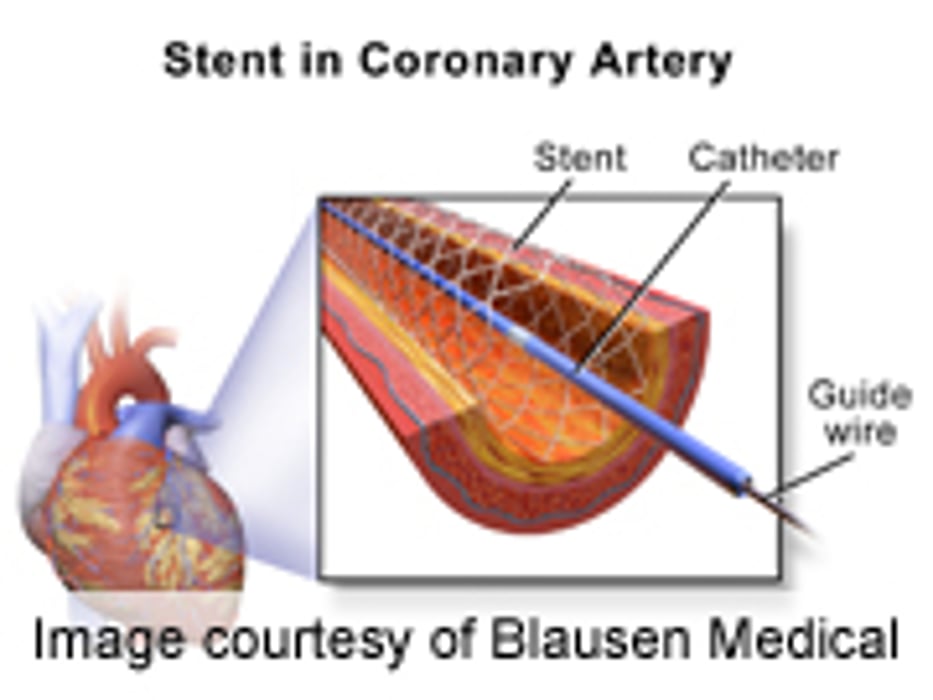 Early Stenting Best for Some Heart Patients: Study
