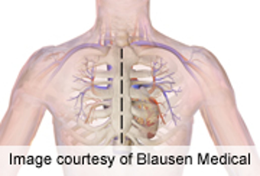 Inactivity Linked With Depression After Cardiac Surgery