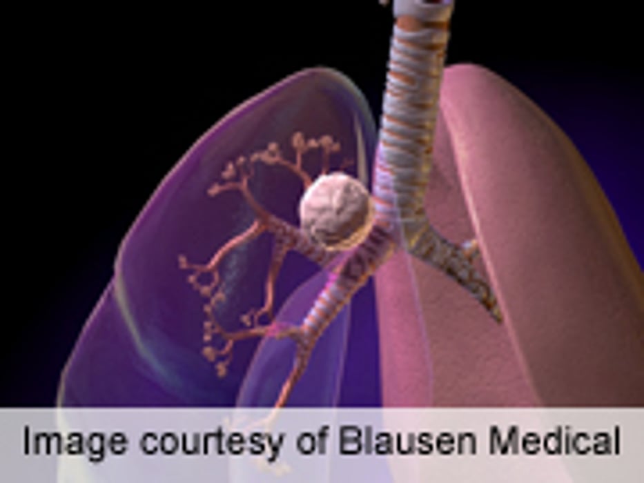 Freezing Treatment May Help Destroy Lung Tumors: Study