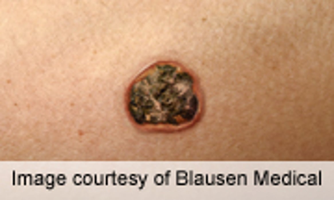 Superficial X-Ray Viable for Basal, Squamous Cell Carcinoma