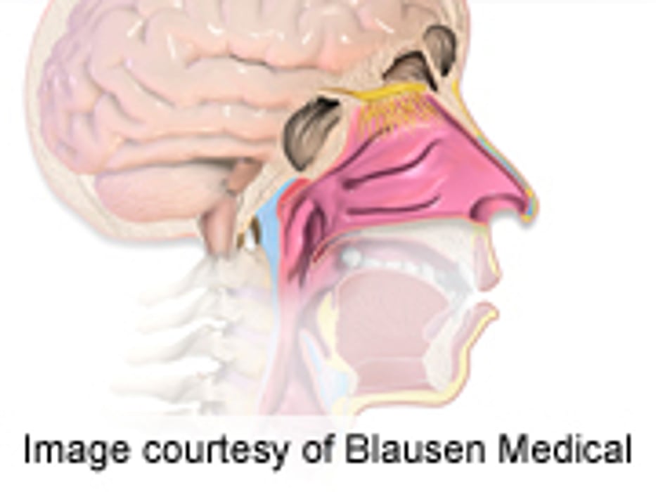 Oral Corticosteroids Deemed Ineffective for Rhinosinusitis