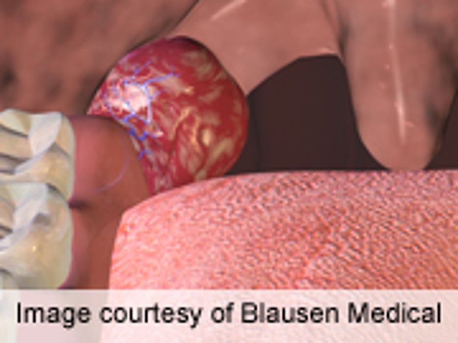Diode Laser Efficient, Safe for Tonsillotomy in Children