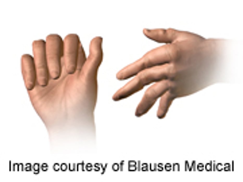 Infection Risk Up for Seniors With Rheumatoid Arthritis