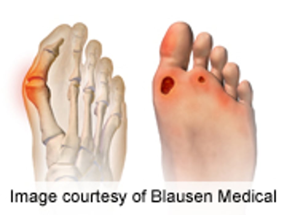 ourselves erection Reserve Plantar-Pressure Based Orthoses Reduce Foot Ulcer Recurrence - Consumer  Health News | HealthDay