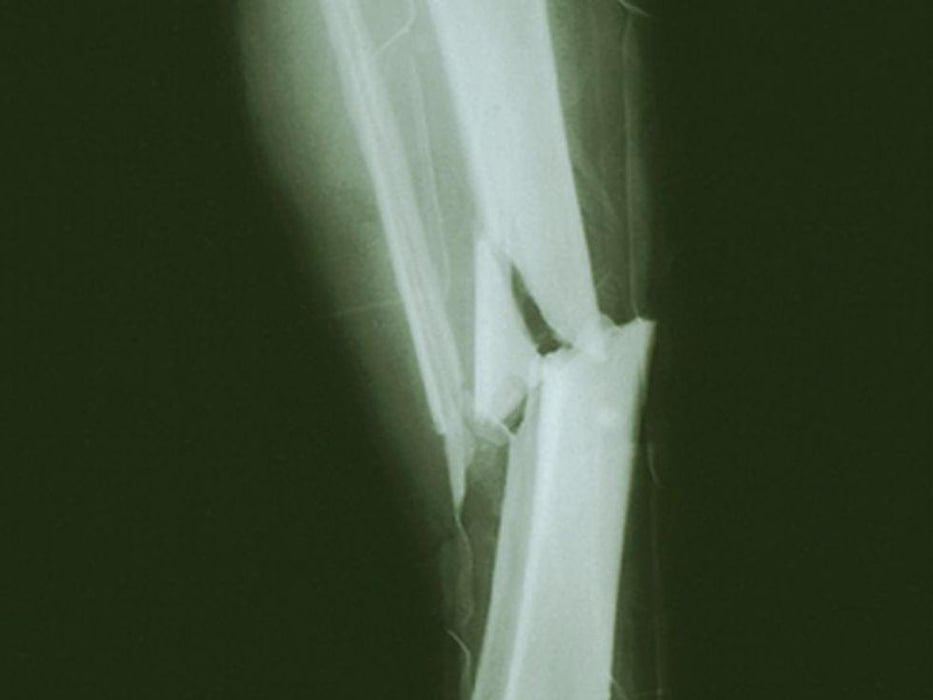 leg fracture