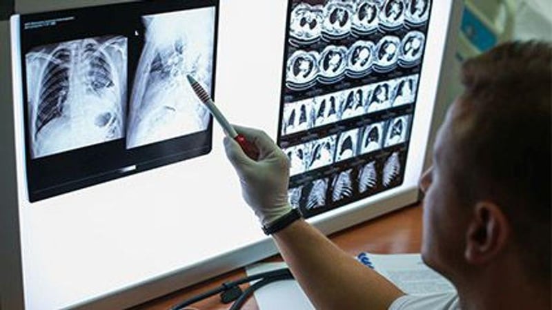 新闻图片:CT肺癌筛查能及早发现更多肿瘤