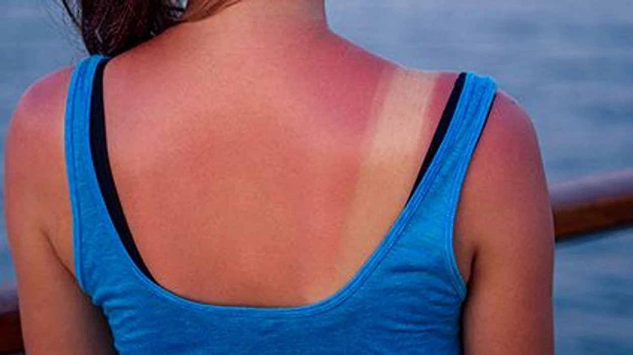 sunburn on the girl's back