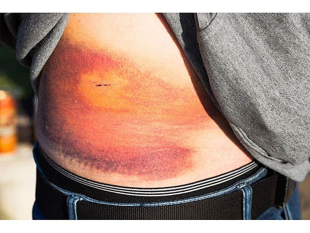 Blow to the Abdomen Consumer Health News HealthDay