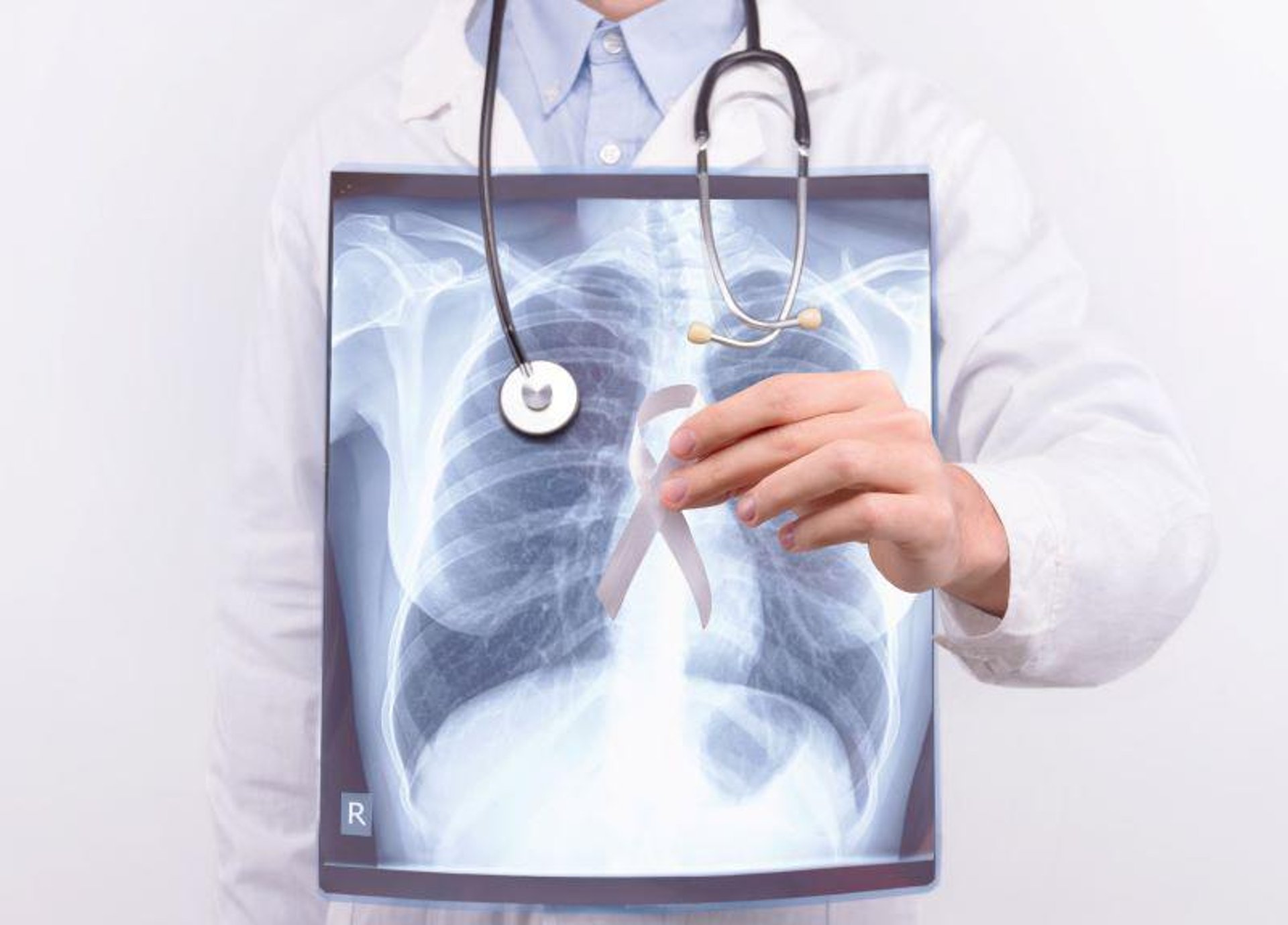 News Picture: Top Medical Groups, Hospitals Urge Better Access to Lung Cancer Screening