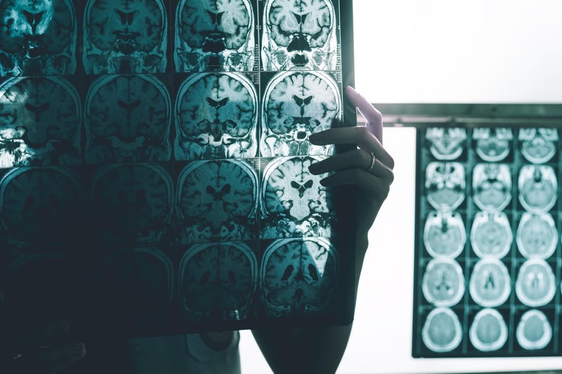 Experimental Alzheimer's Drug May Slow Decline, But Safety Concerns Linger