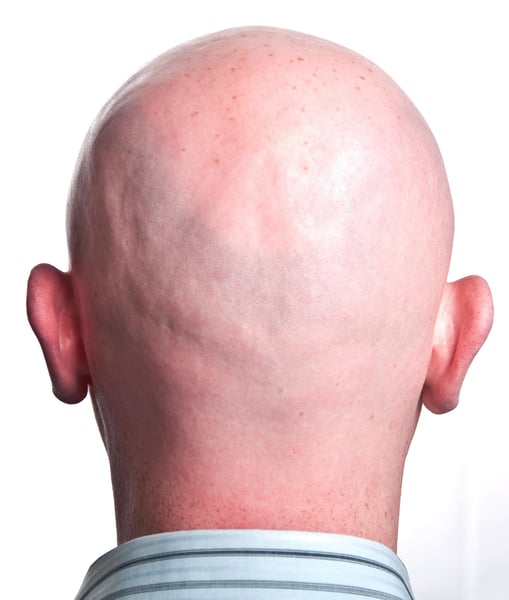 Bald Men, Take Note: Scientists Grow Hair Follicles in the Lab