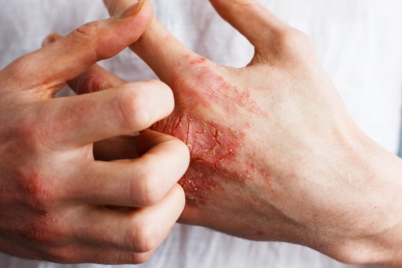 News Picture: Are Your Hands Just Dry, Or Is It Eczema?