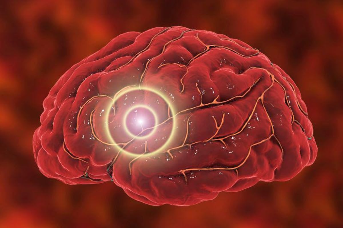 新闻图片:暗示深部脑刺激可能缓解阿尔茨海默症症状