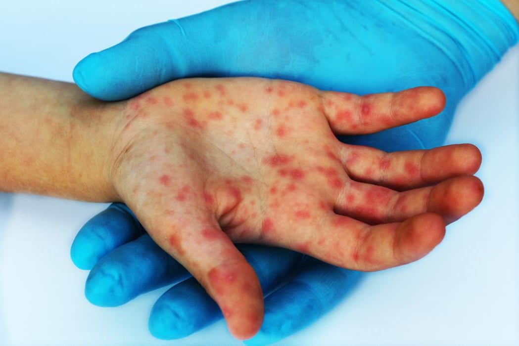 Measles Rash transmission vaccine elimination eradication 