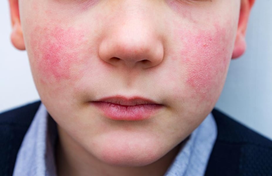 fifth disease in adults