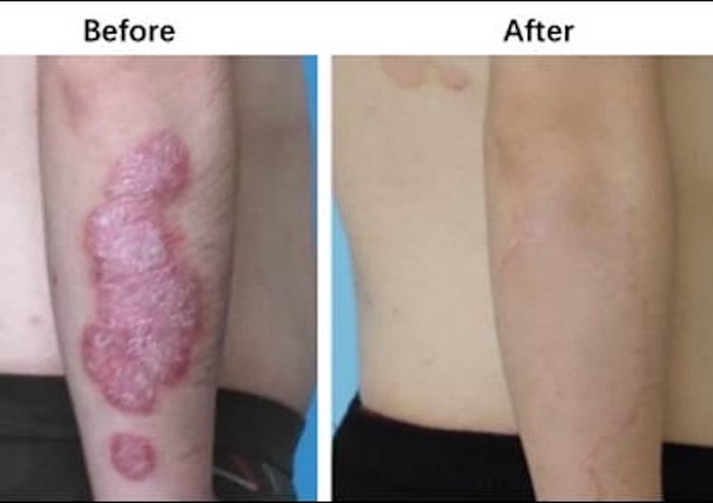 News Picture: Nerve Block Plus Lidocaine Clears Psoriasis in Small Study