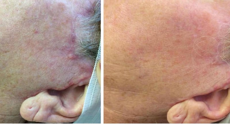 Microneedling Can Help Surgical Scars Fade, Especially If Done Early