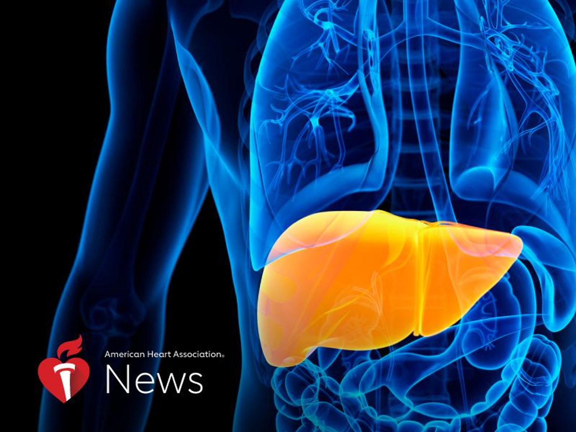 News Picture: AHA News: Fatty Liver Disease May Increase Heart Failure Risk