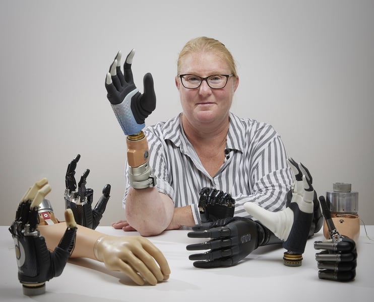 A Bionic Hand Melds With Woman's Own Bone, Nervous System