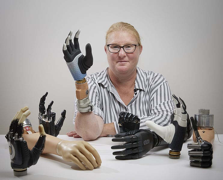 A Bionic Hand Melds With Woman's Own Bone, Nervous System