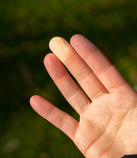 Scientists Spot Genes Linked to Raynaud's Phenomenon