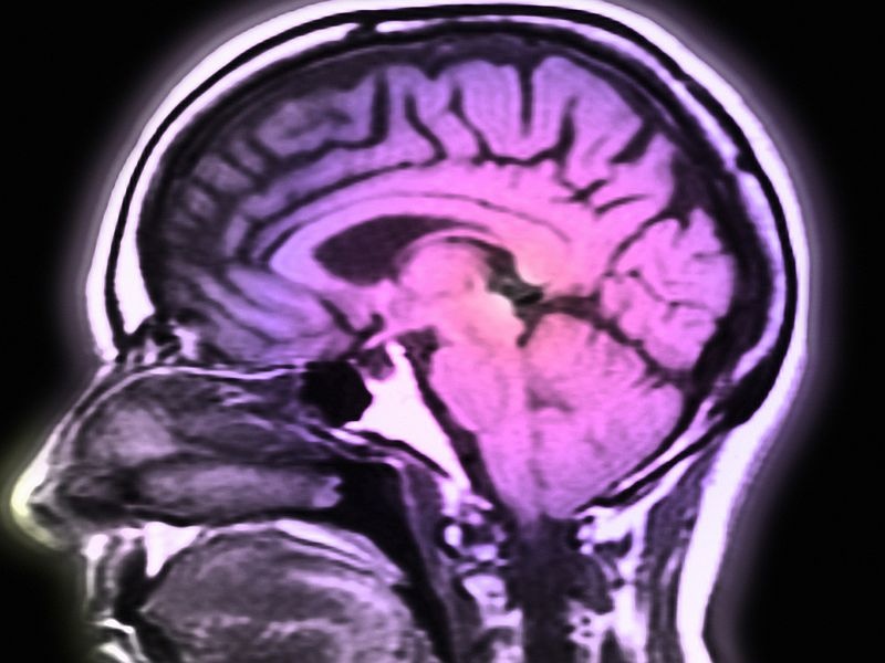 Brain Injuries Raise Long-Term Risk of Stroke