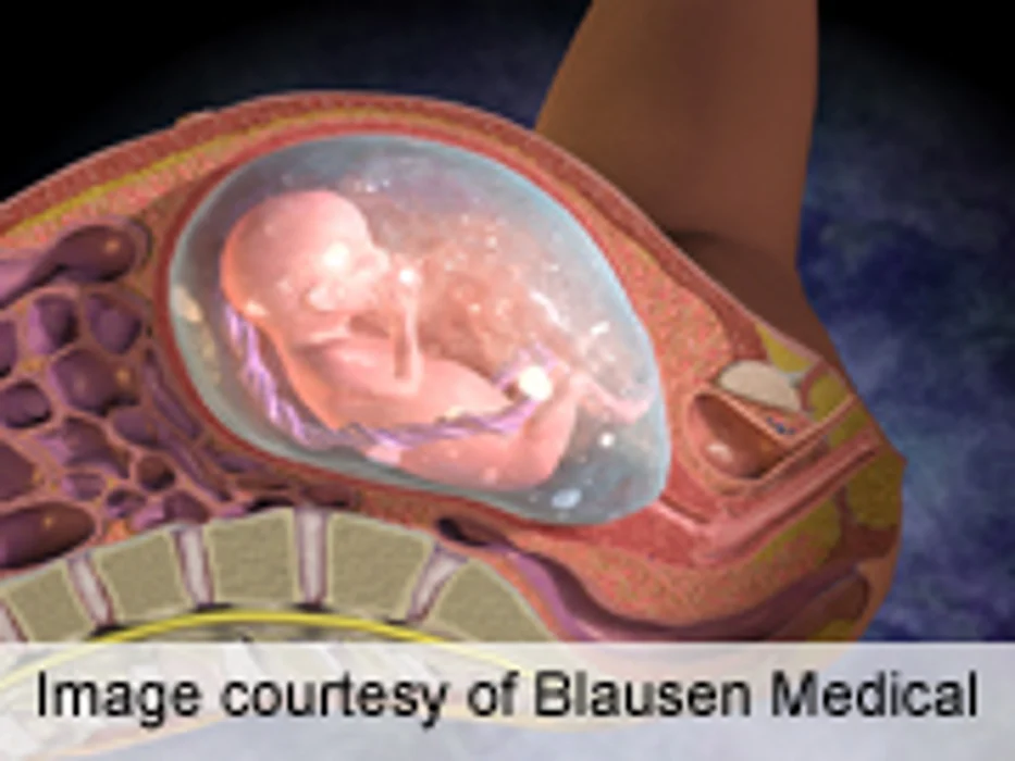 Fetal BPA Exposure to Tied to Childhood Wheeze