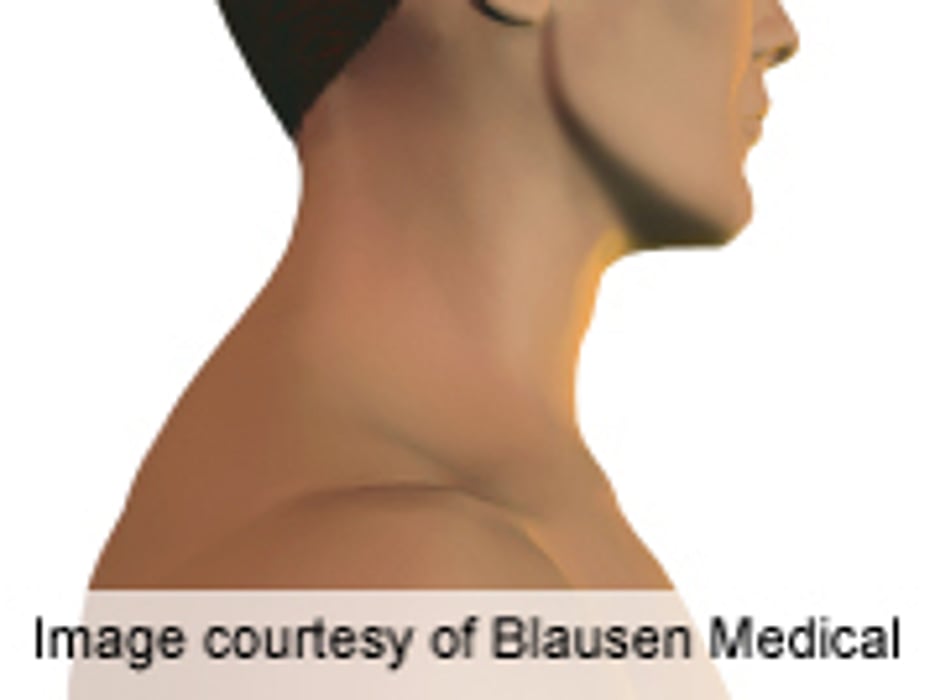 HPV-Related Head, Neck Cancers on the Rise