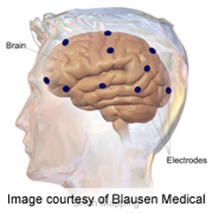 Mouse Study Suggests Alzheimer's Spreads Through Brain Like an Infection
