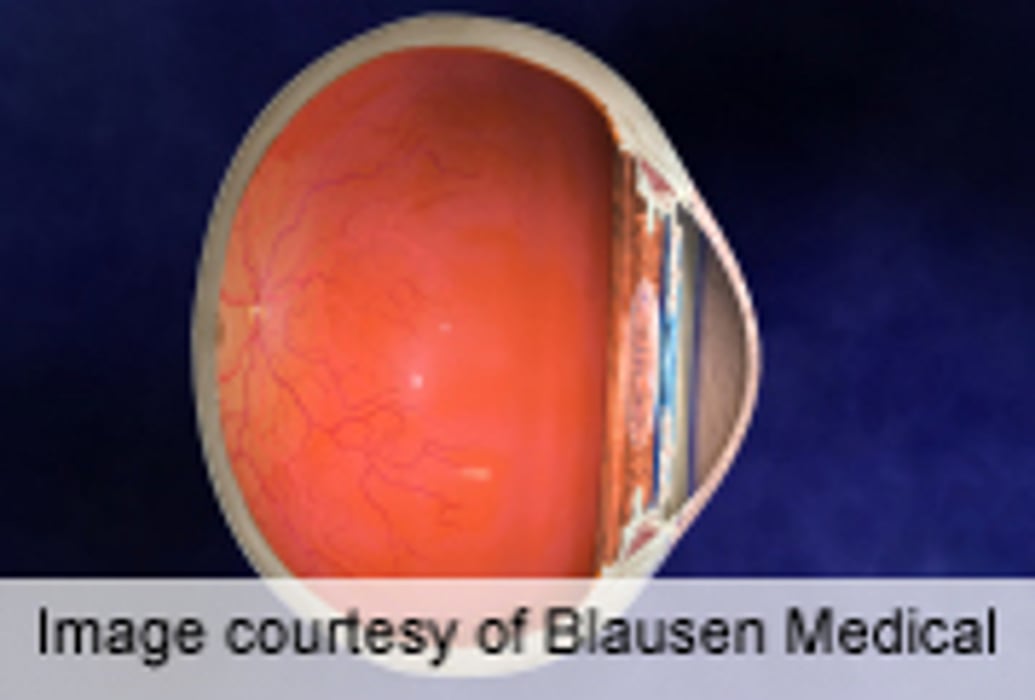 AAO: Researchers Characterize Uveitis With Multiple Sclerosis