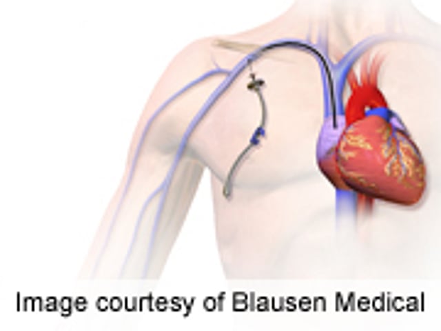 Central Venous Catheters Up Infection Risk in Cancer Patients