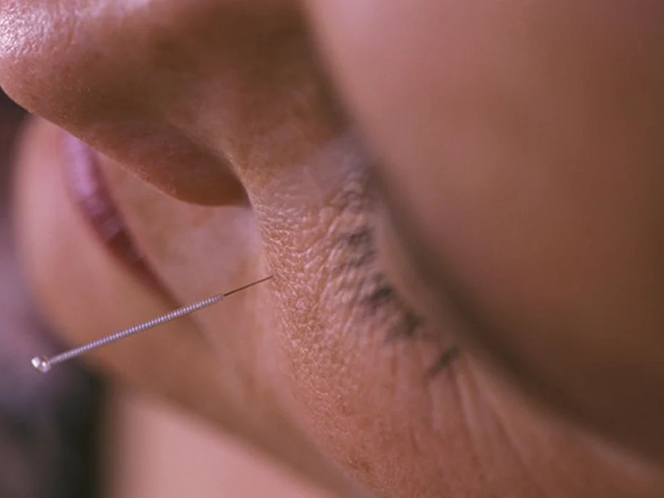 facial acupuncture