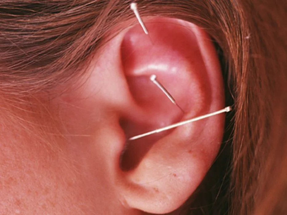 acupuncture on ear