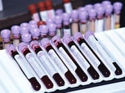 Blood Test Marker Could Gauge Risks After Heart Surgery