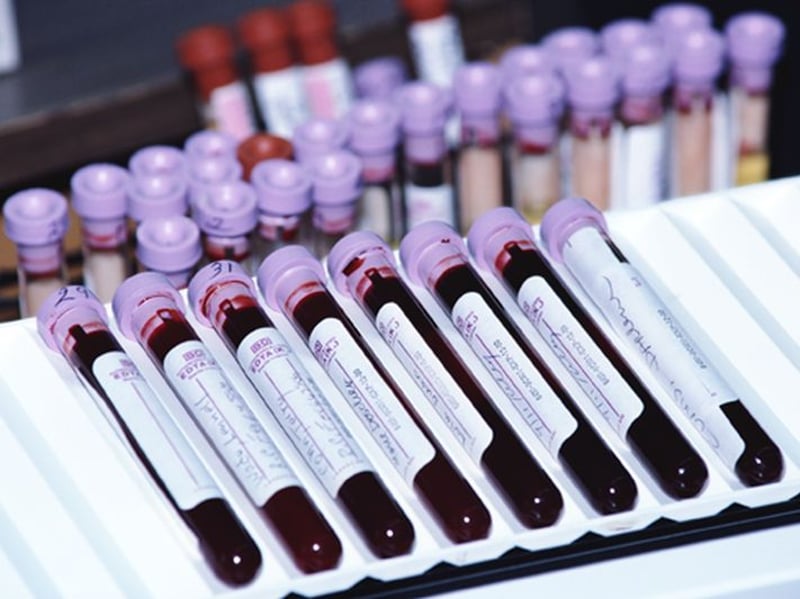 Fotografía de noticias: marcador de análisis de sangre podría medir los riesgos después de una cirugía cardíaca